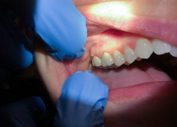 Best Emergency Tooth Extraction in Prospect Park, NJ